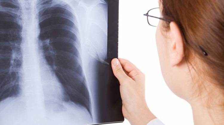 BAJAN LOS CONTAGIOS DE NEUMONÍA Y BRONQUIOLITIS