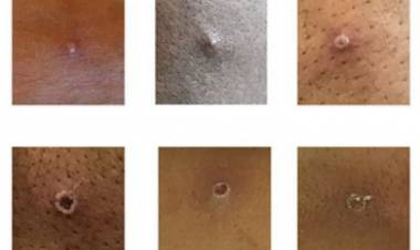 Madrid confirma siete casos de viruela del mono 